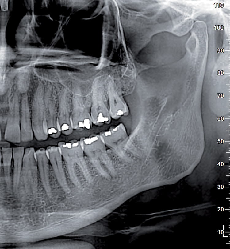 cbct panorama of a patient models mouth