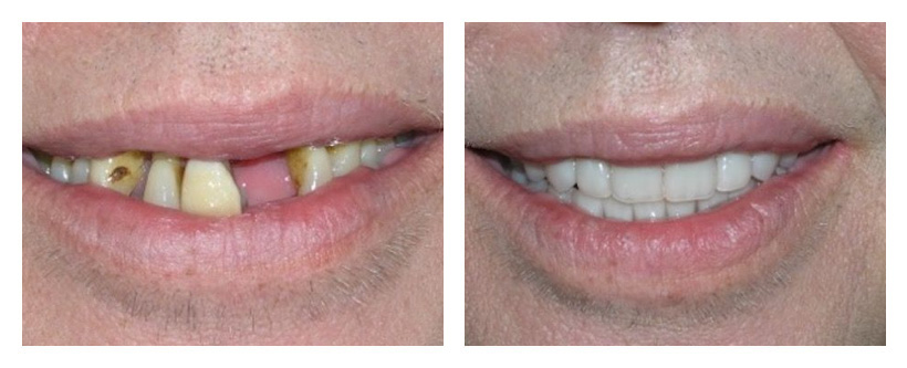 Dental Implants Before And After Photos Dental Implants Before And After Photos