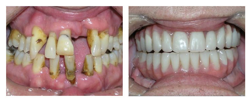 Dental Implants Before And After Photos Dental Implants Before And After Photos