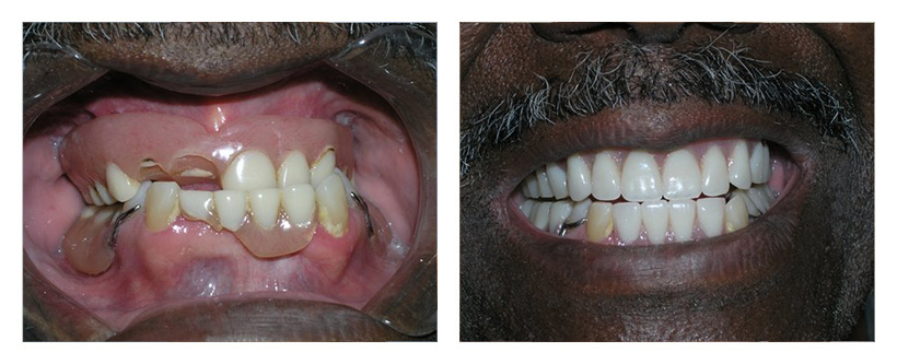 Dentures Before And After Photos Dentures Before And After Photos