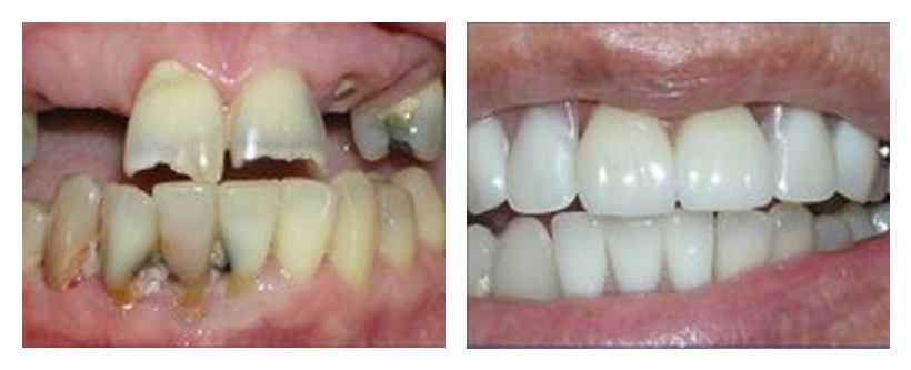 Dental Implants Before And After Photos Dental Implants Before And After Photos
