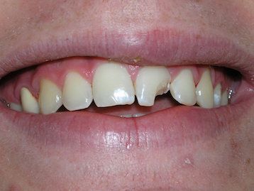 Dental Crowns La Mesa before and after
