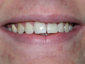 Dental Crowns Gallery Before & After Image