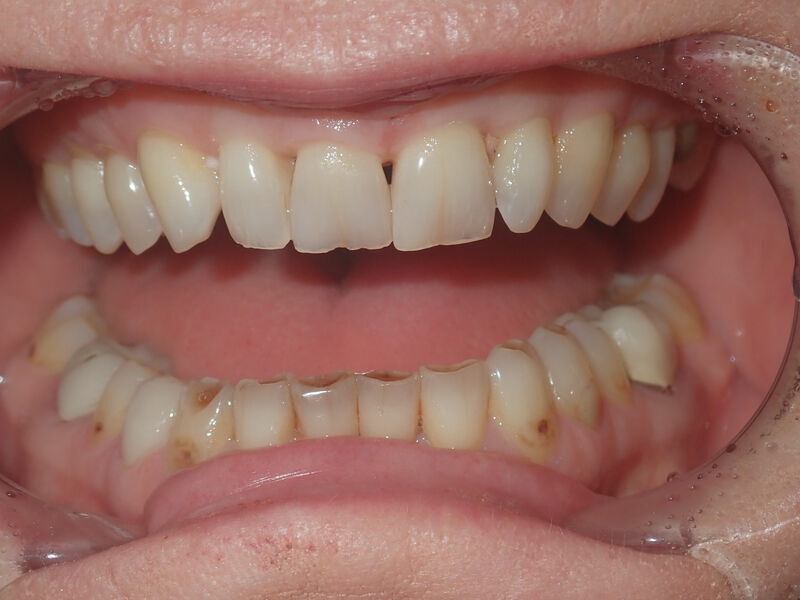 Dental Crowns Gallery Before & After Image