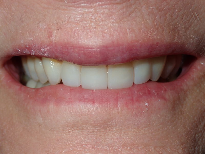 Dental Crowns Gallery Before & After Image