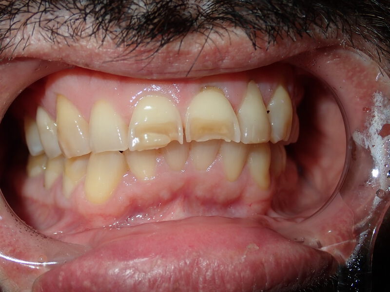 Dental Crowns Gallery Before & After Image