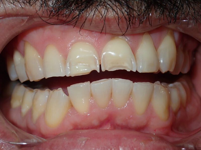 Dental Crowns Gallery Before & After Image