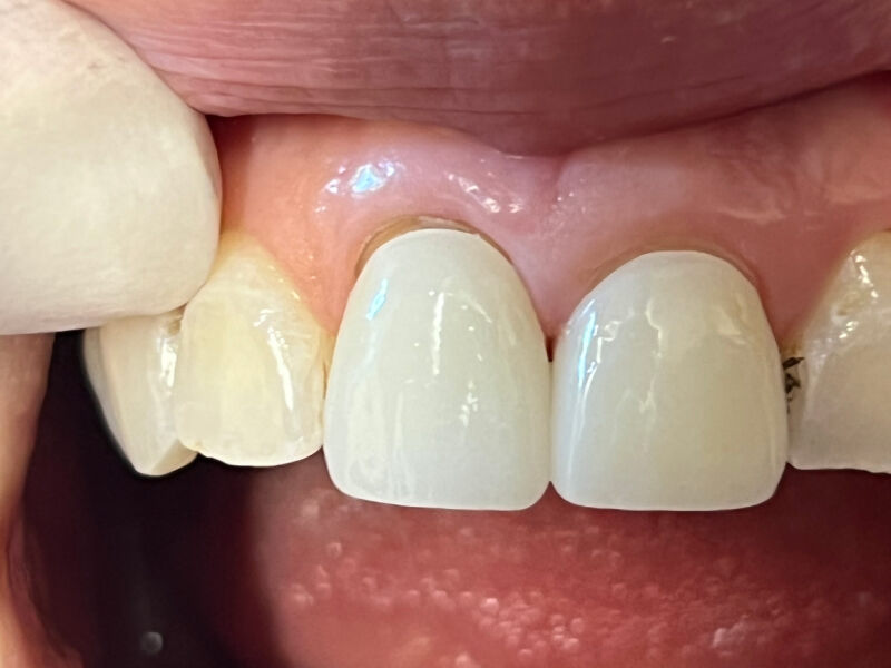 Dental Crowns Gallery Before & After Image