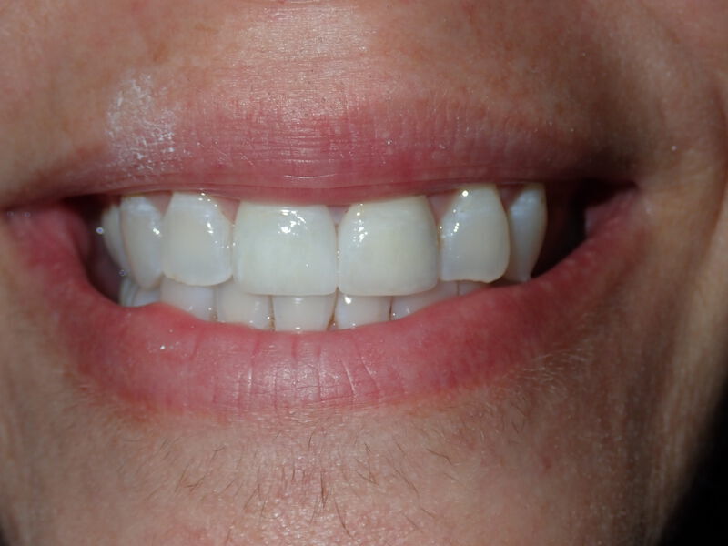 Dental Crowns Gallery Before & After Image