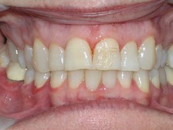 Dentures Gallery Before & After Image