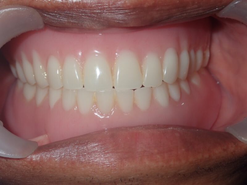 Dentures La Mesa before and after