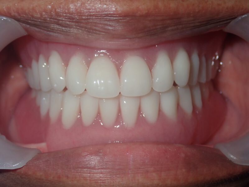 Dentures La Mesa before and after