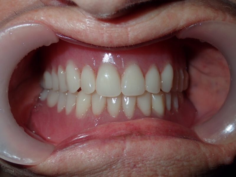 Dentures Gallery Before & After Image