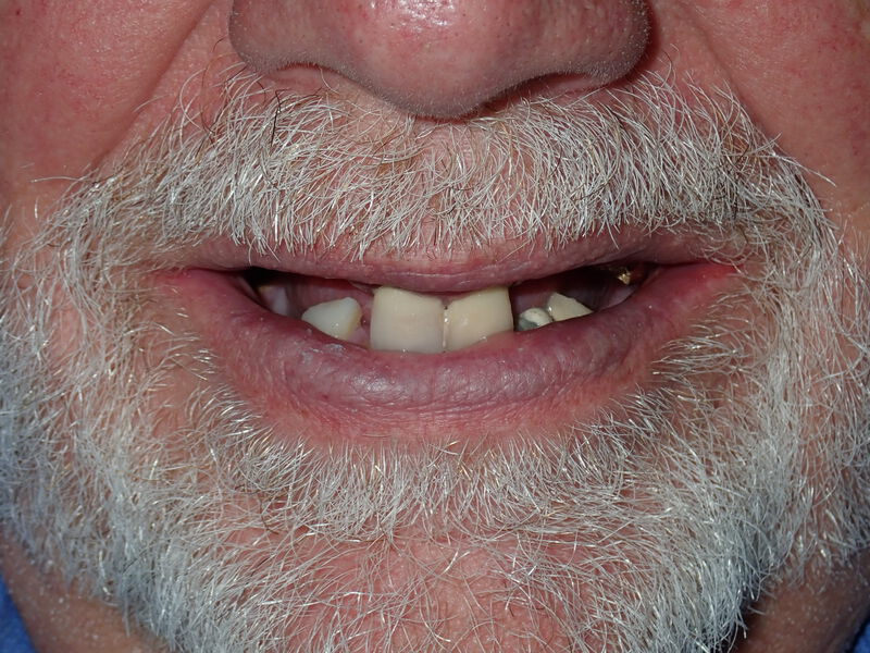 Dentures Gallery Before & After Image