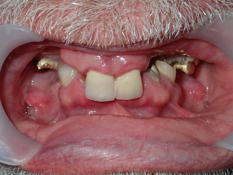 Dentures Gallery Before & After Image