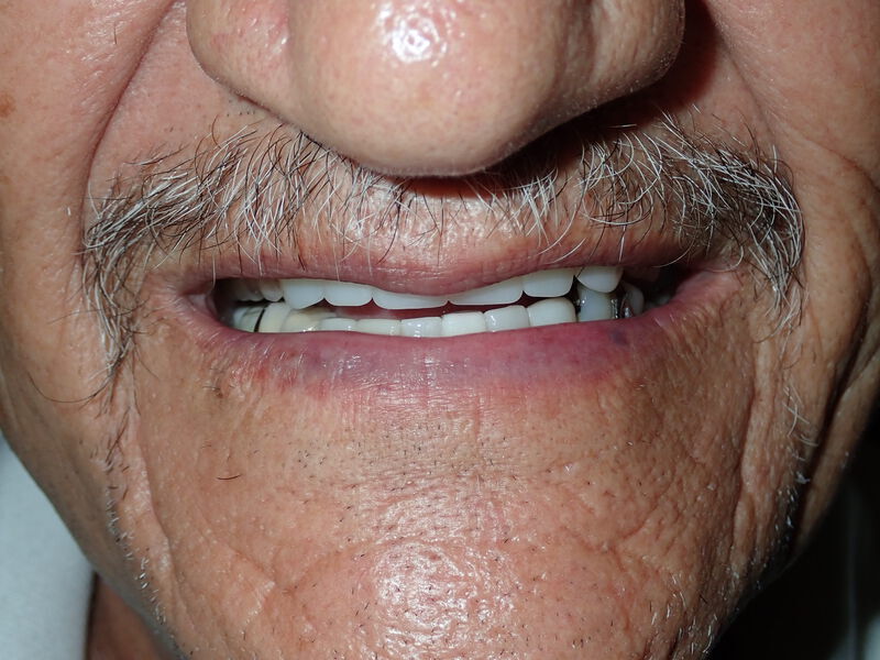 Dentures Gallery Before & After Image