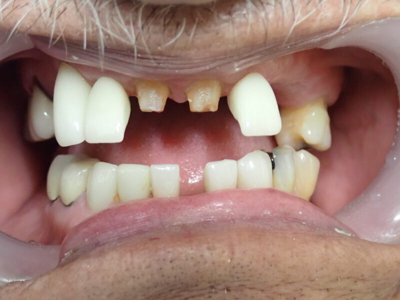 Dentures Gallery Before & After Image