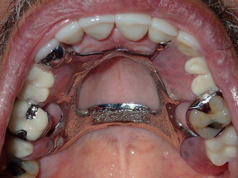 Dentures Gallery Before & After Image