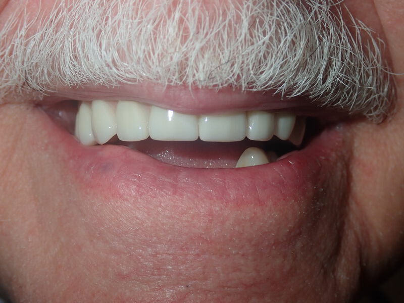 Dentures Gallery Before & After Image