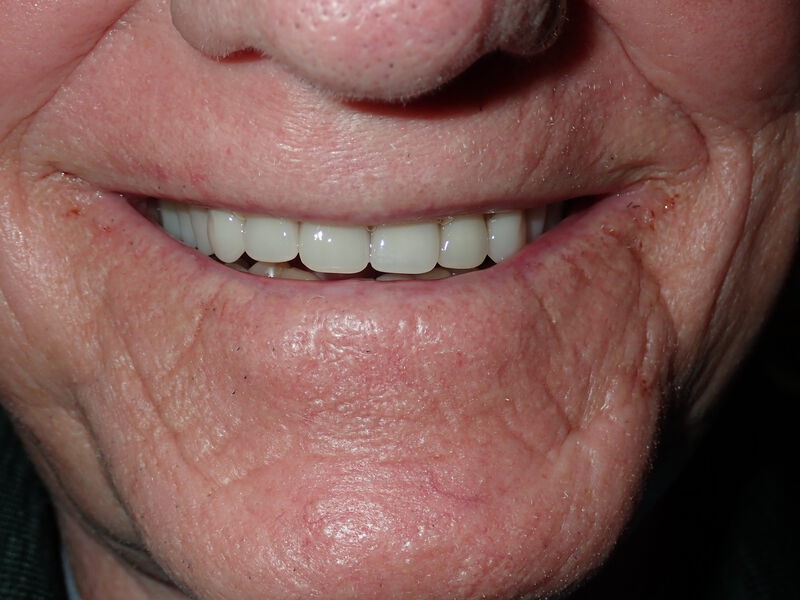 Dentures Gallery Before & After Image