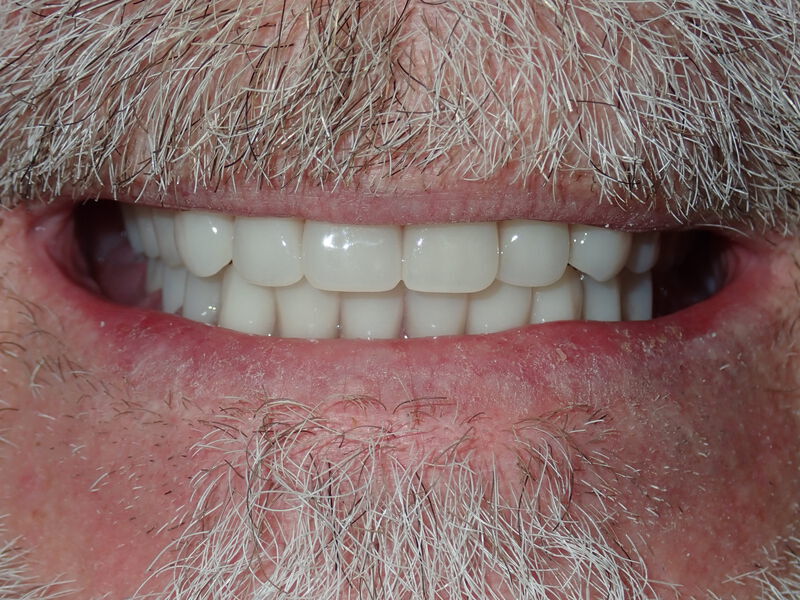 Dentures Gallery Before & After Image