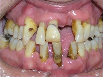 Full Mouth Reconstruction Gallery Before & After Image