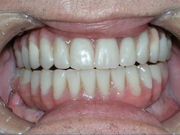 Full Mouth Reconstruction Gallery Before & After Image