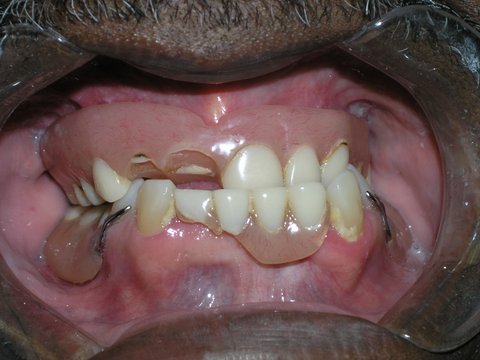 Full Mouth Reconstruction Gallery Before & After Image