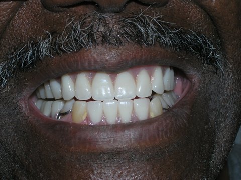 Full Mouth Reconstruction Gallery Before & After Image