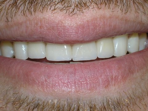 Full Mouth Reconstruction Gallery Before & After Image