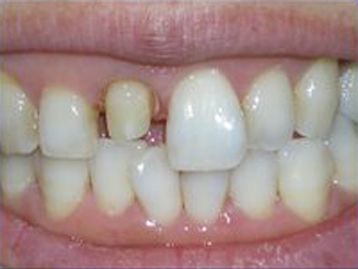 Full Mouth Reconstruction Gallery Before & After Image