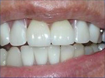 Full Mouth Reconstruction Gallery Before & After Image