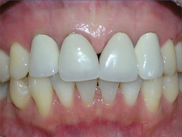 Full Mouth Reconstruction La Mesa before and after