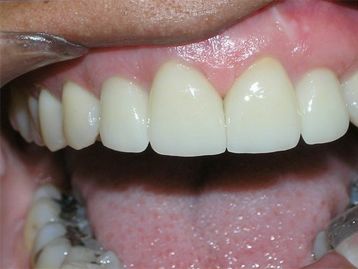 Full Mouth Reconstruction La Mesa before and after