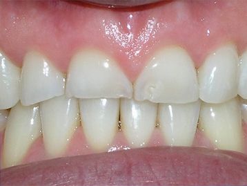 Full Mouth Reconstruction Gallery Before & After Image