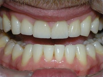 Full Mouth Reconstruction Gallery Before & After Image