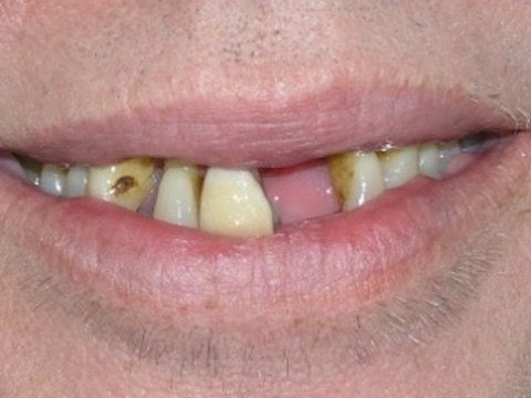 Full Mouth Reconstruction Gallery Before & After Image