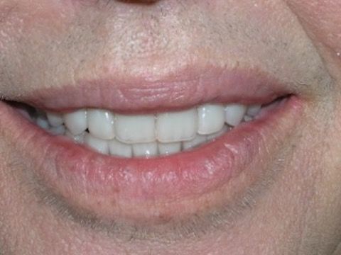 Full Mouth Reconstruction Gallery Before & After Image