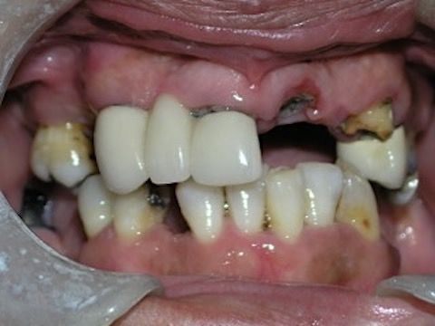 Full Mouth Reconstruction Gallery Before & After Image