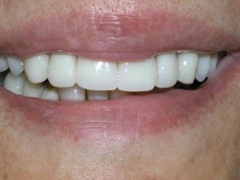 Full Mouth Reconstruction Gallery Before & After Image