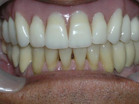 Full Mouth Reconstruction Gallery Before & After Image