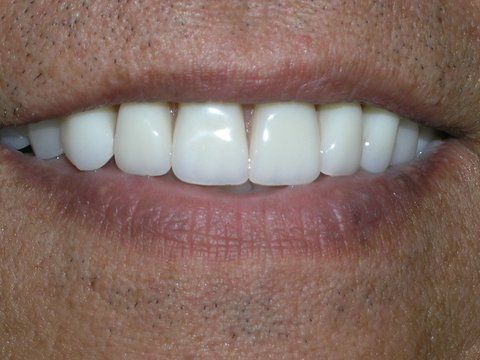 Full Mouth Reconstruction Gallery Before & After Image