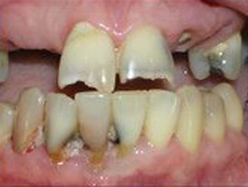 la mesa Dental Implants before and after