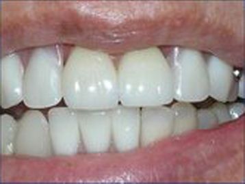 La Mesa Dental Implants before and after