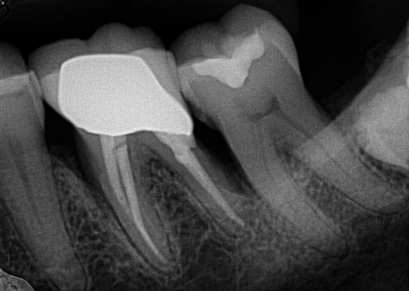 LANAP Laser Gallery Before & After Image