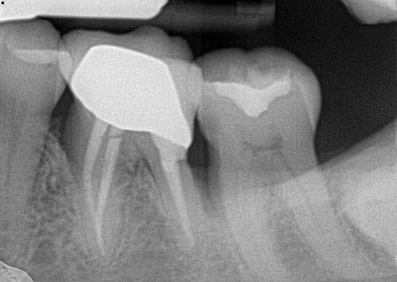 Porcelain lanap-laser In La Mesa before and after