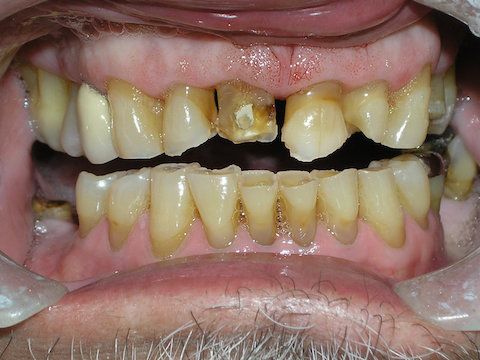 Veneers Gallery Before & After Image