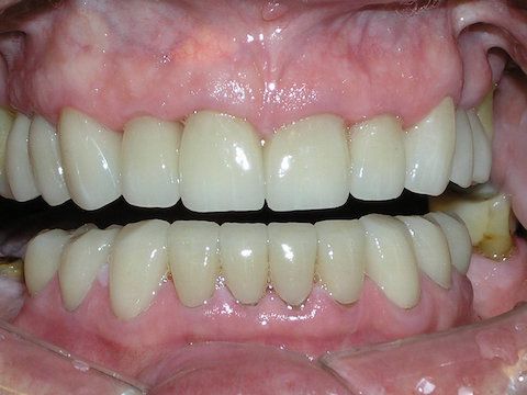 Veneers Gallery Before & After Image