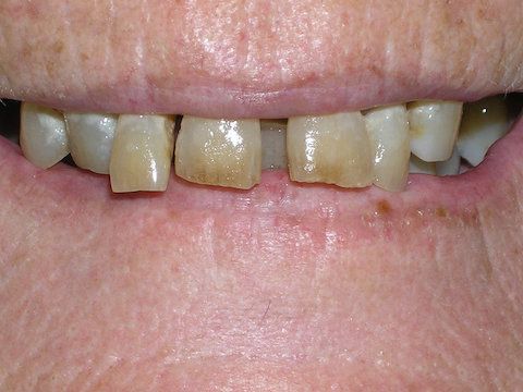 Porcelain Veneers In La Mesa before and after