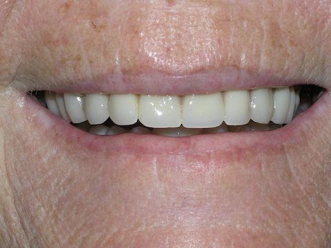 Porcelain Veneers In La Mesa before and after